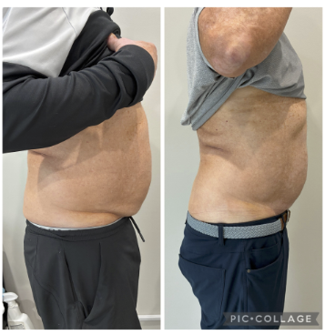 Before and after T-Shape 2 treatment on male flanks