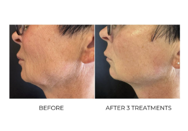 Before and after T-Shape 2 treatment on the jawline and neck