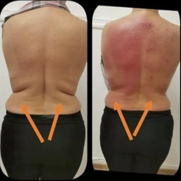 Before and after T-Shape 2 treatment on the back and flanks