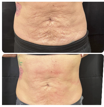 Before and after T-Shape 2 treatment on the abdomen