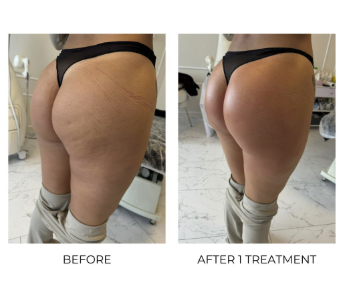 Before and after T-Shape 2 treatment on the glutes