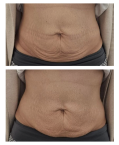 Before and after T-Shape 2 treatment on stomach skin tightening